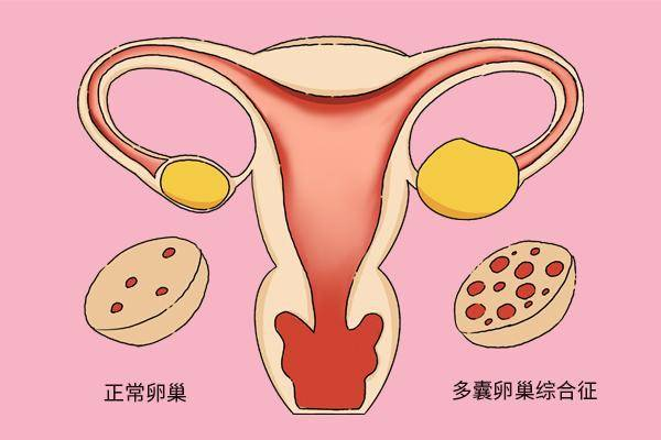 康仙媞科普：什麽是多囊卵巢？